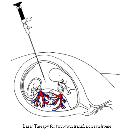 Laser Therapy for twin-twin transfusion syndrome