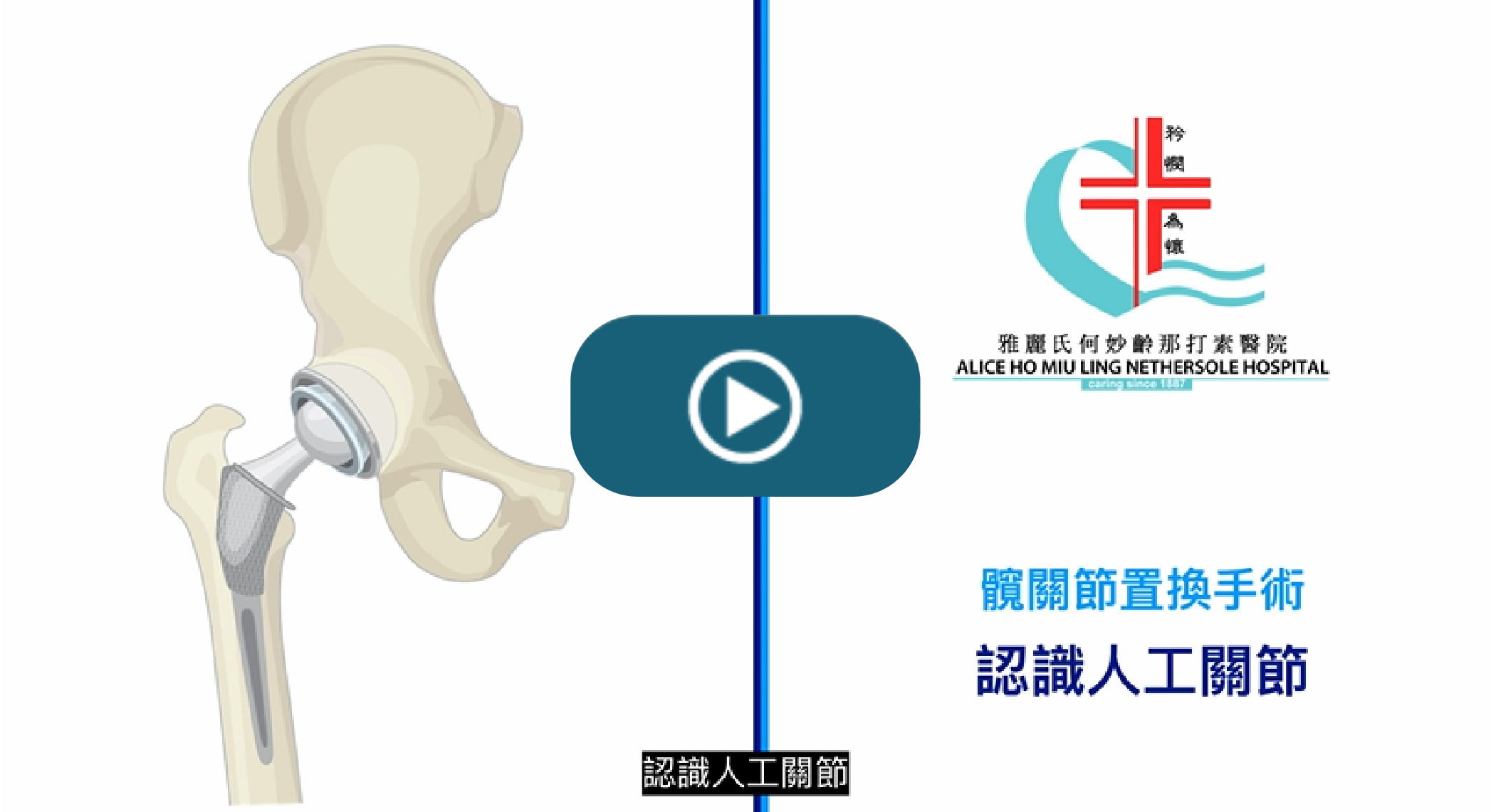 Understanding hip replacement
