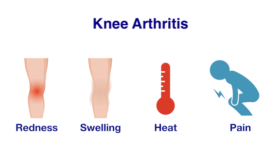 Knee Arthritis