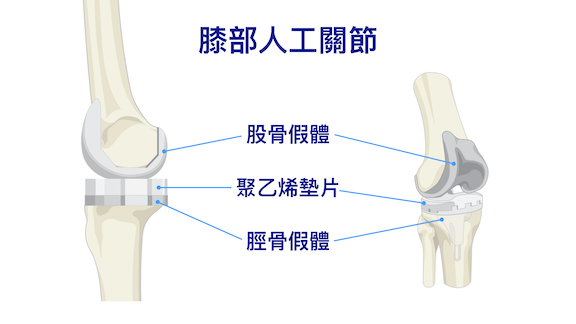 認識膝關節置換手術