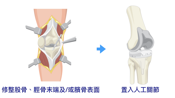 認識膝關節置換手術