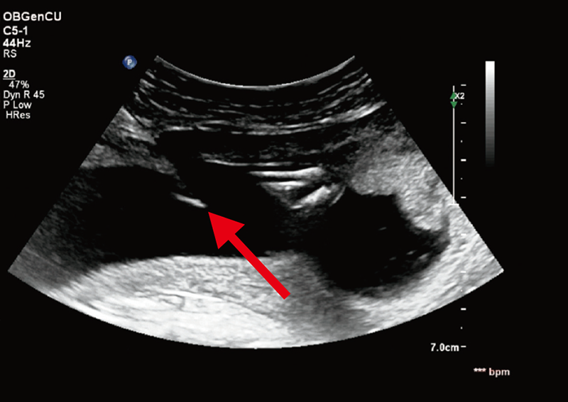 Amniocentesis is usually performed between the 16th to 20th week of gestation. A sample of liquid surrounding the foetus is taken by a fine needle (arrow) for chromosomal analysis.