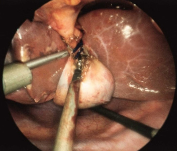 Laparoscopic Cholecystectomy