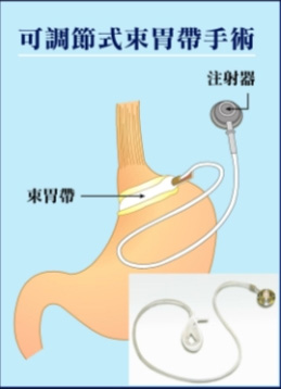 Laparoscopic surgery for treatment of morbid obesity