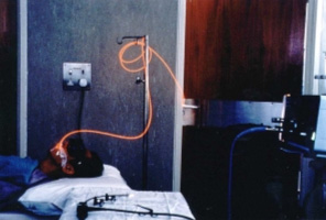 Photodynamic therapy for treating nasopharyngeal cancer