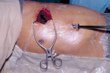 Video-assisted thoracoscopic lobectomy