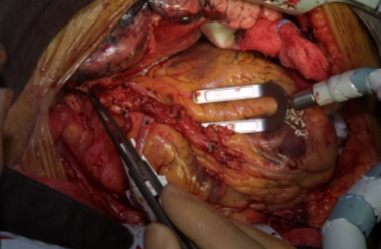 Coronary artery by-pass surgery