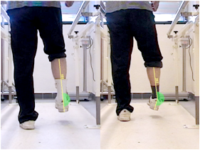 Clinical gait analysis and recommendation